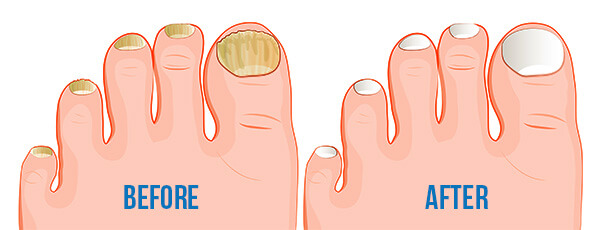 Best Black Toenail Fungus Treatment