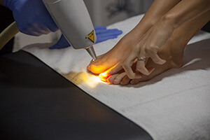 Laser toenail fungus treatment