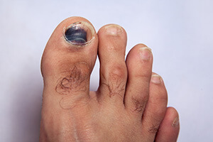 What Does Black Toenail Fungus Look Like