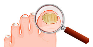 What is the cause of black toenail fungus