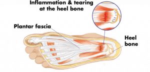 What Are the Causes of Plantar Fasciitis?