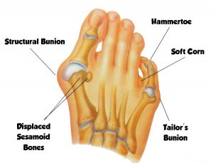 What Are Bunions