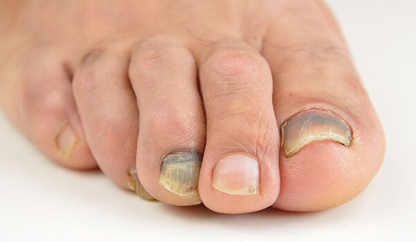 Bruised Toenail: Learn About Its Causes, Treatment and Prevention