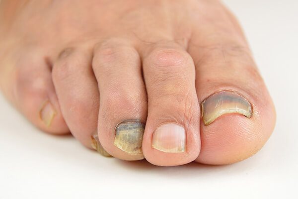 Bruised Toenail: Learn About Its Causes, Treatment and Prevention