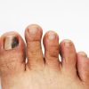 Black Spot on Toenail: Causes, Treatments, and Home Remedies