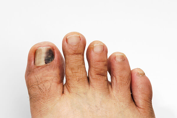 Spot toenail black under Subungual Melanoma