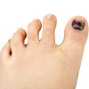 Black Toenail Fungus: Causes, Home Remedies, Treatments and More