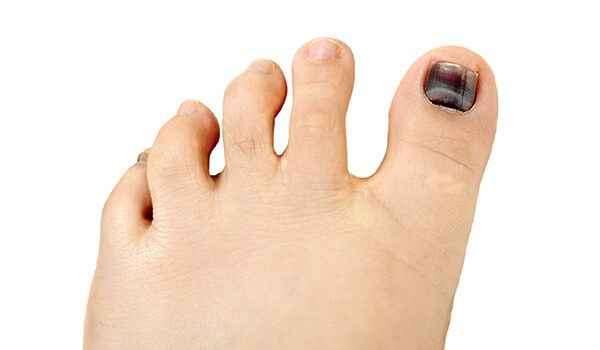 Black Toenail Fungus: Causes, Home Remedies, Treatments and More