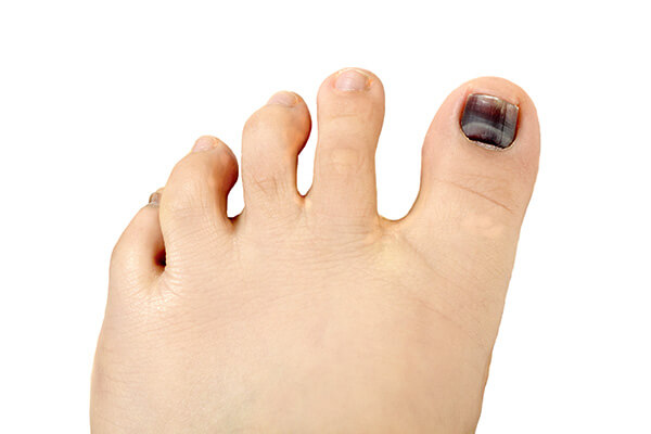 Black Toenail Fungus: Causes, Home Remedies, Treatments and More