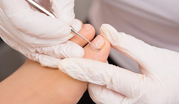 White Spots on Toenails: Its Nature, Causes, Prevention, and Treatment