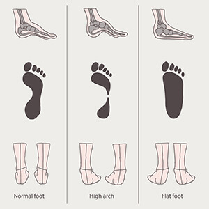 Foot arch types