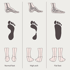 Foot Arch Types: What You Need To Know | FootGearLab