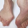 14 Effective Foot Exercises for Bunions