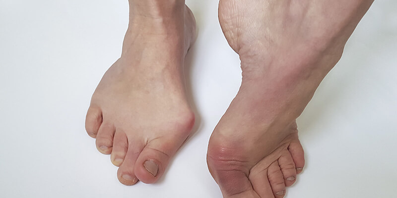 14 Effective Foot Exercises for Bunions