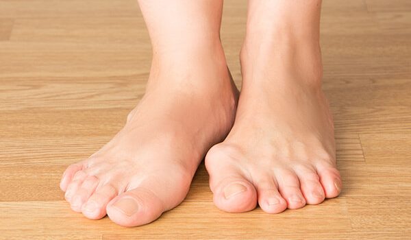 How to Get Rid of Bunions Without Surgery in 12 Easy Ways