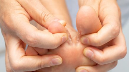 7 Home Remedies for Athlete’s Foot: Natural Relief at Home