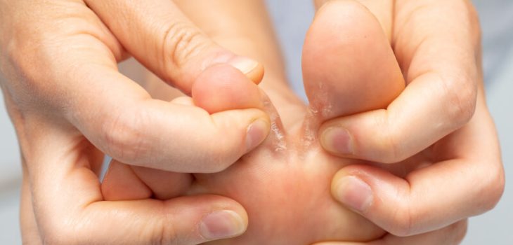 Home Remedies for Athlete's Foot: Natural Relief at Home