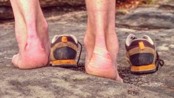 How to Avoid and Treat Blisters from Running