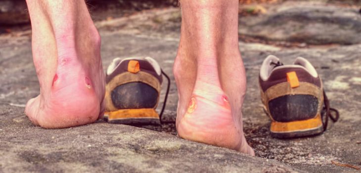 How to Avoid and Treat Blisters from Running