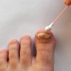How to Get Rid of Toenail Fungus: A Complete Guide