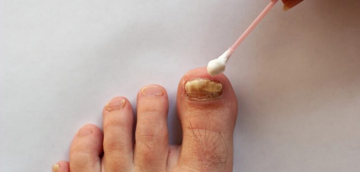 How to Get Rid of Toenail Fungus: A Complete Guide