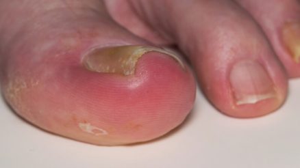 Ingrown Toenail Prevention and Treatment