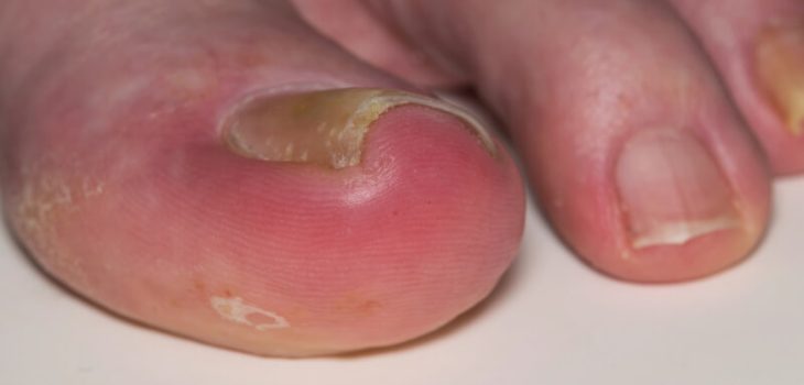 Ingrown Toenail Prevention and Treatment