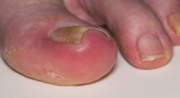 Ingrown Toenail Prevention and Treatment