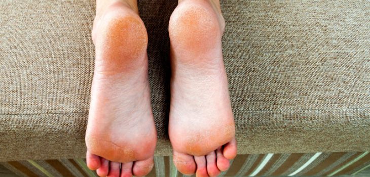 7 Natural Ways to Soften Hard Skin on Feet