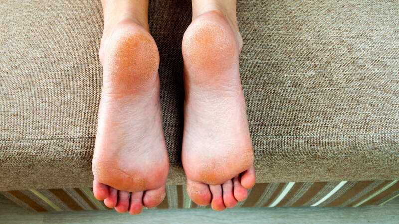 How To Soften Hard Skin On Feet