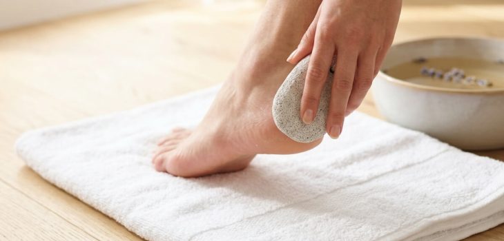 How to Get Rid of Corns and Calluses